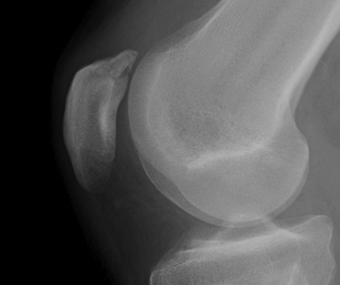 Patella Fracture nonunion